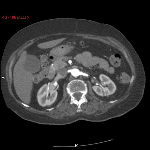 File:Aortic intramural hematoma (Radiopaedia 27746-28001 A 106).jpg