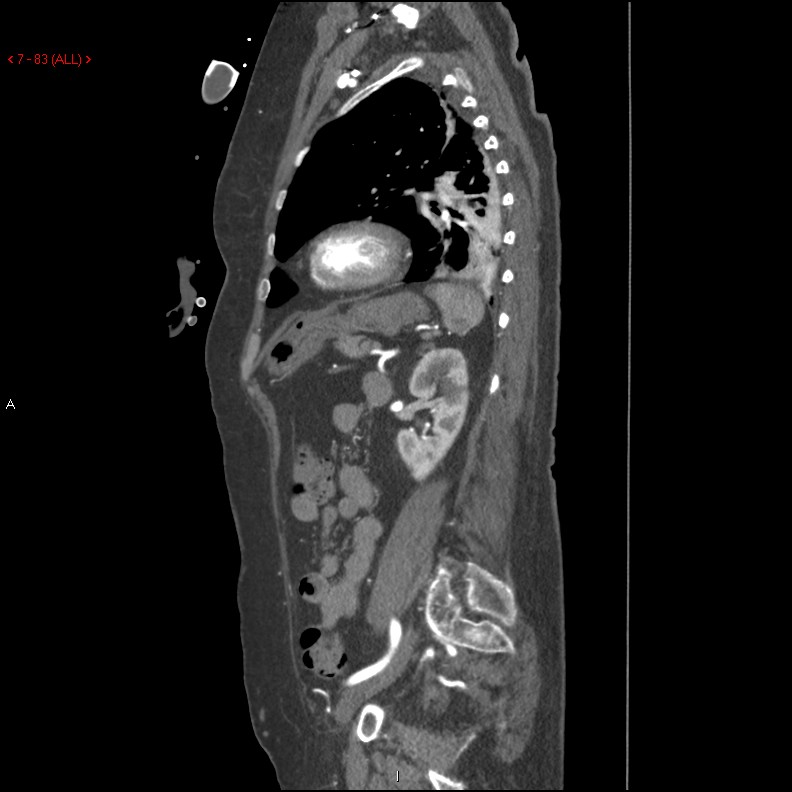 Aortic intramural hematoma (Radiopaedia 27746-28001 C 52).jpg