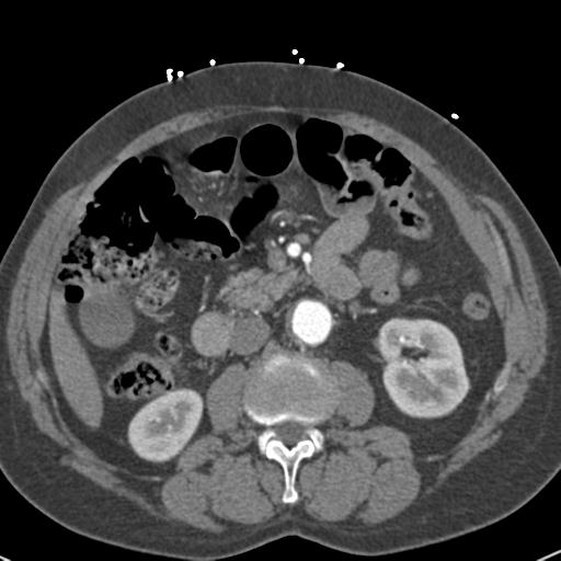 File:Aortic intramural hematoma (Radiopaedia 31139-31838 B 104).jpg