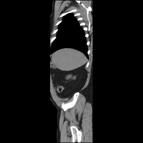 Aortic intramural hematoma (type B) (Radiopaedia 79323-92387 G 1).jpg