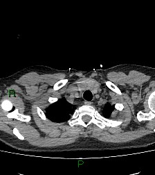 Aortic valve endocarditis (Radiopaedia 87209-103485 Axial non-contrast 15).jpg