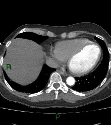 File:Aortic valve endocarditis (Radiopaedia 87209-103485 C 71).jpg
