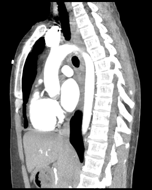 Aortic valve non-coronary cusp thrombus (Radiopaedia 55661-62189 D 28).png