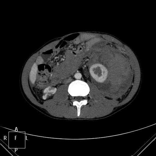 File:Aorto-left renal vein fistula (Radiopaedia 45534-49628 A 35).jpg