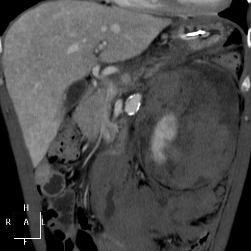 Aorto-left renal vein fistula (Radiopaedia 45534-49628 B 16).jpg