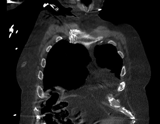 Aortoesophageal fistula with endovascular repair (Radiopaedia 73781-84592 Coronal C+ CTPA 12).jpg