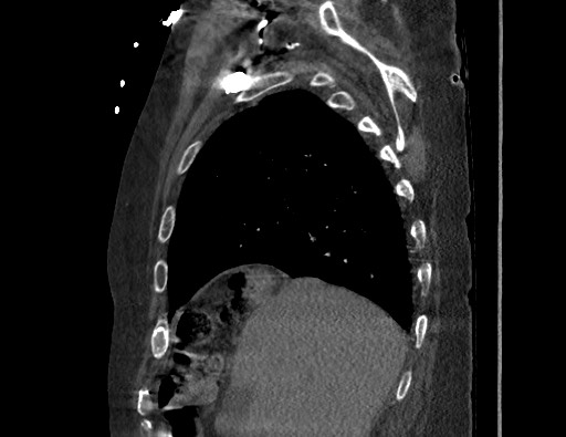 Aortoesophageal fistula with endovascular repair (Radiopaedia 73781-84592 Sagittal C+ CTPA 35).jpg