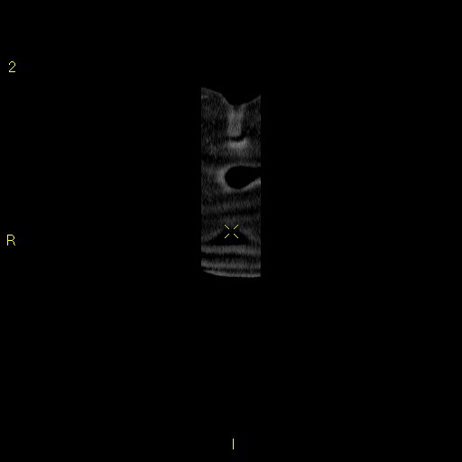 File:Aortoiliac occlusive disease (Radiopaedia 16828-16548 B 2).jpg