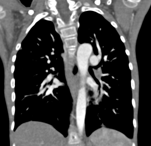 File:Aortopulmonary window, interrupted aortic arch and large PDA giving the descending aorta (Radiopaedia 35573-37074 D 45).jpg