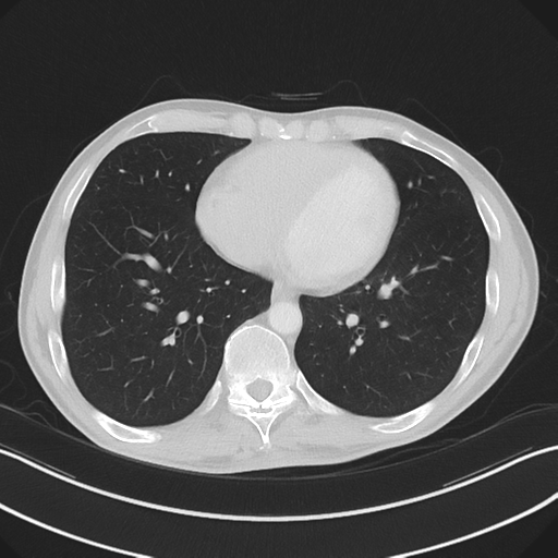 Apical pleural calcification (Radiopaedia 46141-50499 Axial lung window 48).png