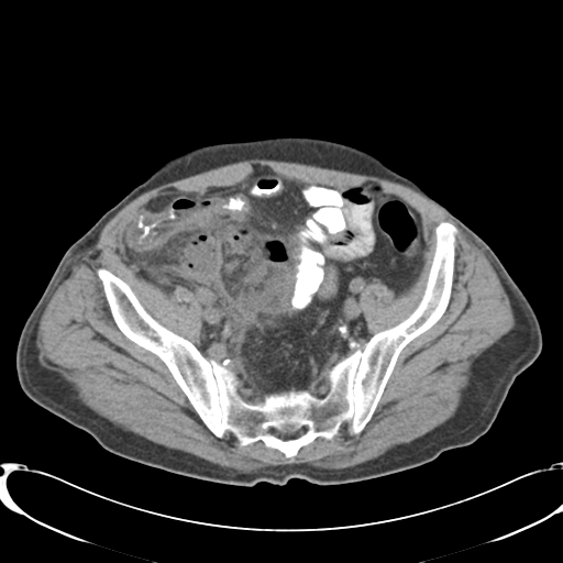 File:Appendiceal abscesses (Radiopaedia 50999-56542 Axial non-contrast 64).png