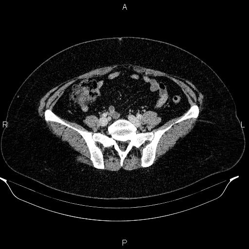 Appendiceal mucocele (Radiopaedia 83280-97688 Axial With contrast 76).jpg
