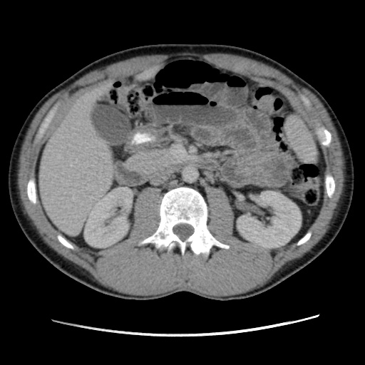 File:Appendicitis complicated by post-operative collection (Radiopaedia 35595-37114 A 35).jpg