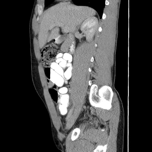 Appendicitis complicated by post-operative collection (Radiopaedia 35595-37114 C 29).jpg