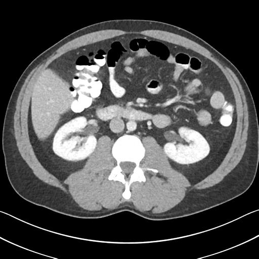 File:Appendicitis with cecal bar sign (Radiopaedia 31878-32830 B 37).jpg