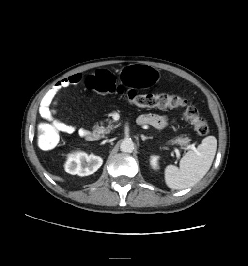 Appendicitis with localized perforation and abscess formation (Radiopaedia 49035-54130 A 34).jpg