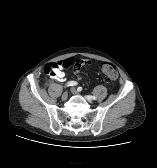 Appendicitis with localized perforation and abscess formation (Radiopaedia 49035-54130 A 66).jpg