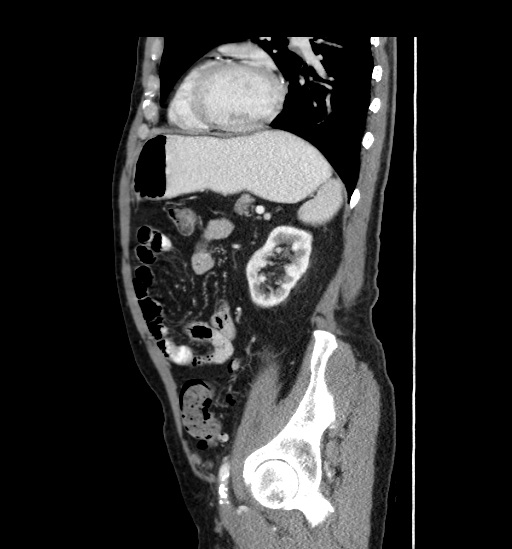Appendicitis with localized perforation and abscess formation (Radiopaedia 49035-54130 C 46).jpg