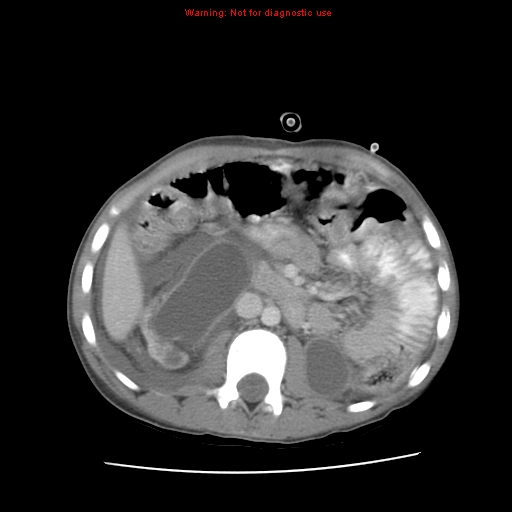 Appendicitis with phlegmon (Radiopaedia 9358-10046 A 32).jpg