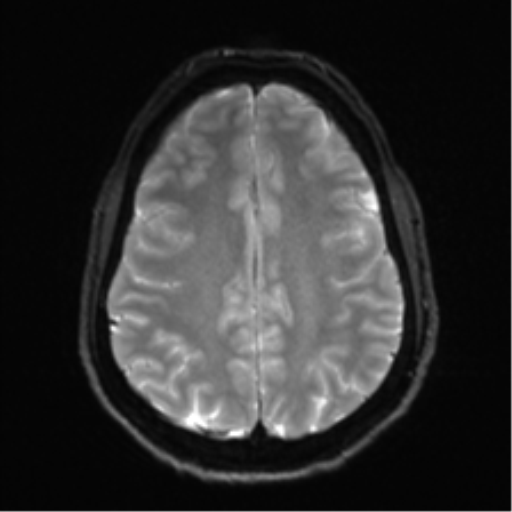 Arachnoid cyst - cerebellopontine angle (Radiopaedia 59689-67083 Axial DWI 26).png