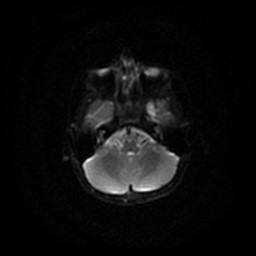 Arachnoid cyst - middle cranial fossa (Radiopaedia 86780-102938 Axial DWI 52).jpg