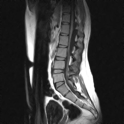 File:Arachnoid cyst - spinal (Radiopaedia 66835-76157 Sagittal T1 5).jpg