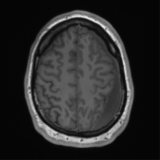 File:Arachnoid cyst with subdural hematoma (Radiopaedia 85892-101743 Axial T1 67).png