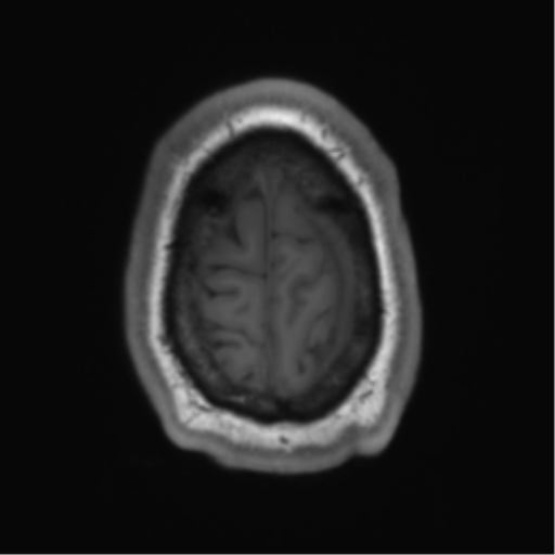 File:Arachnoid cyst with subdural hematoma (Radiopaedia 85892-101743 Axial T1 77).png