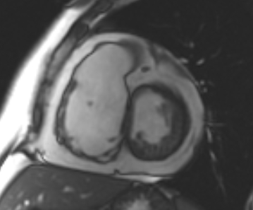 Arrhythmogenic right ventricular cardiomyopathy (Radiopaedia 69431-79307 Short axis cine 153).jpg
