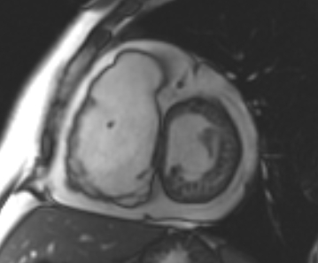 Arrhythmogenic right ventricular cardiomyopathy (Radiopaedia 69431-79307 Short axis cine 156).jpg