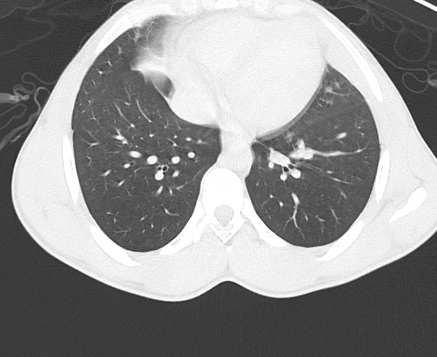 Arrow injury to the chest (Radiopaedia 75223-86321 Axial lung window 59).jpg
