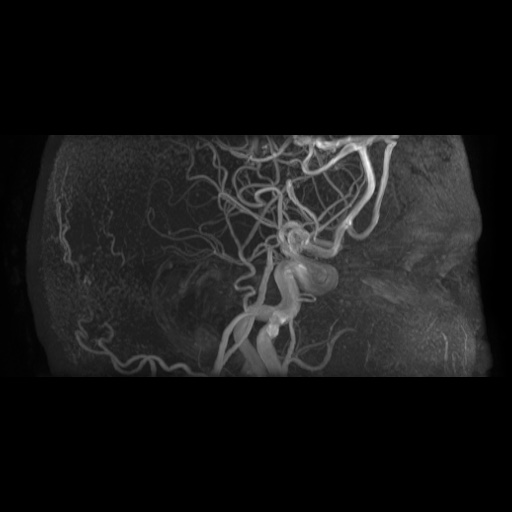 Arteriovenous malformation (Radiopaedia 71628-81999 Axial MRA 19).jpg