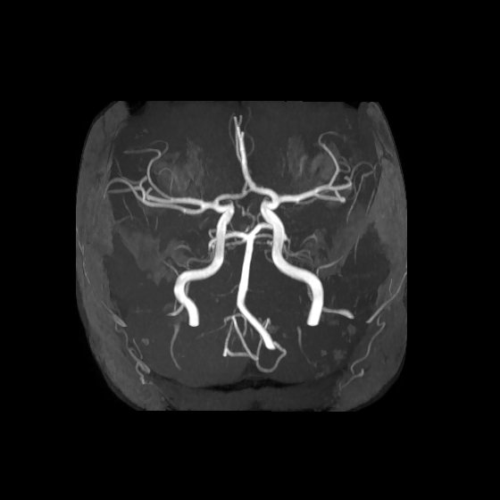Artery of Percheron infarct (Radiopaedia 40966-43676 F 11).jpg