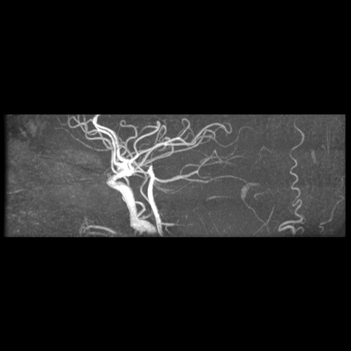 Artery of Percheron infarction (Radiopaedia 27975-28230 3D TOF 2).jpg