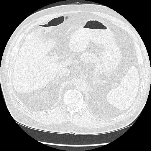 Asbestos-related pleural disease (Radiopaedia 74366-85250 Axial lung window 114).jpg