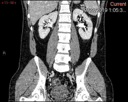File:Ascending colonic diverticulum mimicking acute appendicitis (Radiopaedia 69943-80198 B 98).jpg