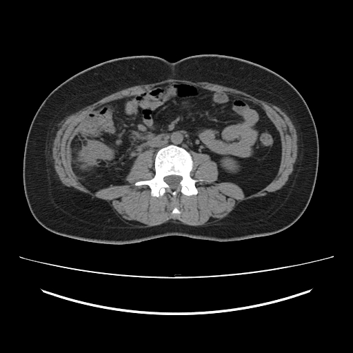 Ascending retrocecal appendicitis with liver abscesses (Radiopaedia 60066-67615 Axial non-contrast 47).jpg