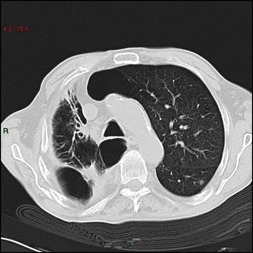 File:Aspergilloma (Radiopaedia 14842-14787 Axial lung window 15).jpg