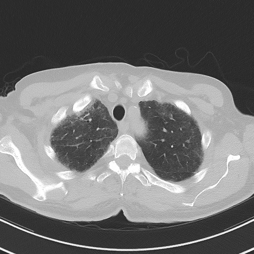 Aspergilloma on background pulmonary fibrosis (Radiopaedia 60942-68757 A 12).jpg