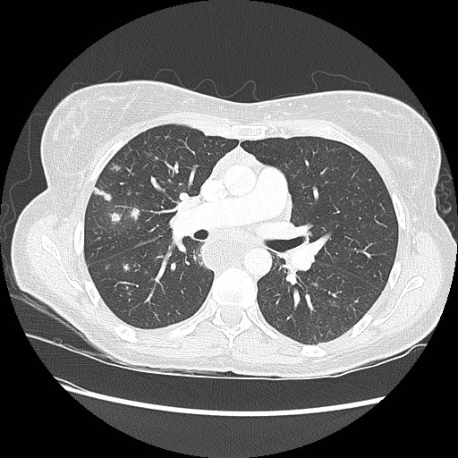 Aspiration pneumonia secondary to laparoscopic banding (Radiopaedia 18345-18183 lung window 49).jpg