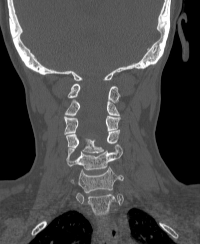Atlanto-occipital assimilation with basilar invagination (Radiopaedia 70122-80188 Coronal bone window 128).jpg