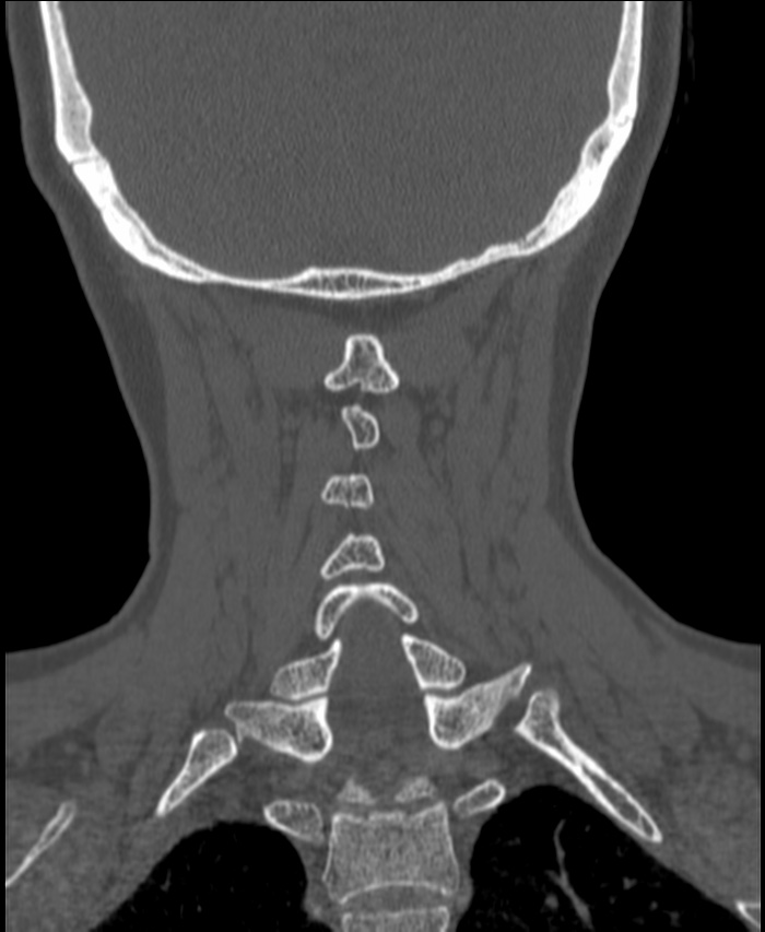 Atlanto-occipital assimilation with basilar invagination (Radiopaedia 70122-80188 Coronal bone window 174).jpg