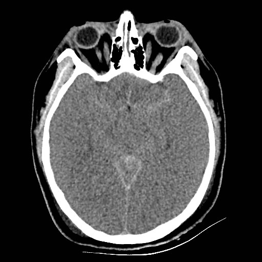 Atlanto-occipital dislocation (Radiopaedia 44648-48412 Axial non-contrast 24).jpg