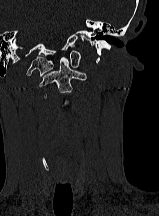 Atlantoaxial subluxation (Radiopaedia 44681-48450 Coronal bone window 15).jpg