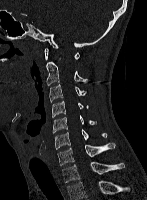Atlantoaxial subluxation (Radiopaedia 44681-48450 Sagittal bone window 89).jpg