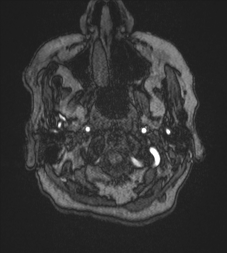 Atypical meningioma (WHO Grade II) (Radiopaedia 54742-60981 Axial MRA 3).png