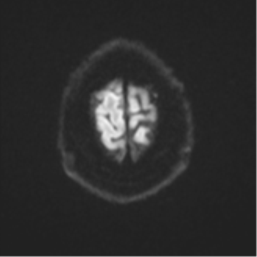 Atypical meningioma (WHO grade II) with brain invasion (Radiopaedia 57767-64729 Axial DWI 58).png