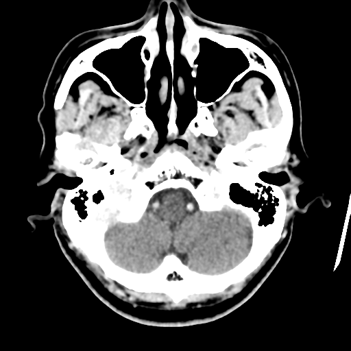 Atypical meningioma (WHO grade II) with osseous invasion (Radiopaedia 53654-59715 Axial C+ delayed 10).png