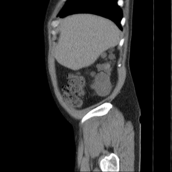 Autosomal dominant polycystic kidney disease (Radiopaedia 36539-38101 D 13).jpg