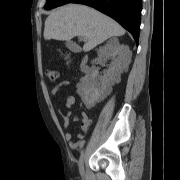 Autosomal dominant polycystic kidney disease (Radiopaedia 36539-38101 D 28).jpg